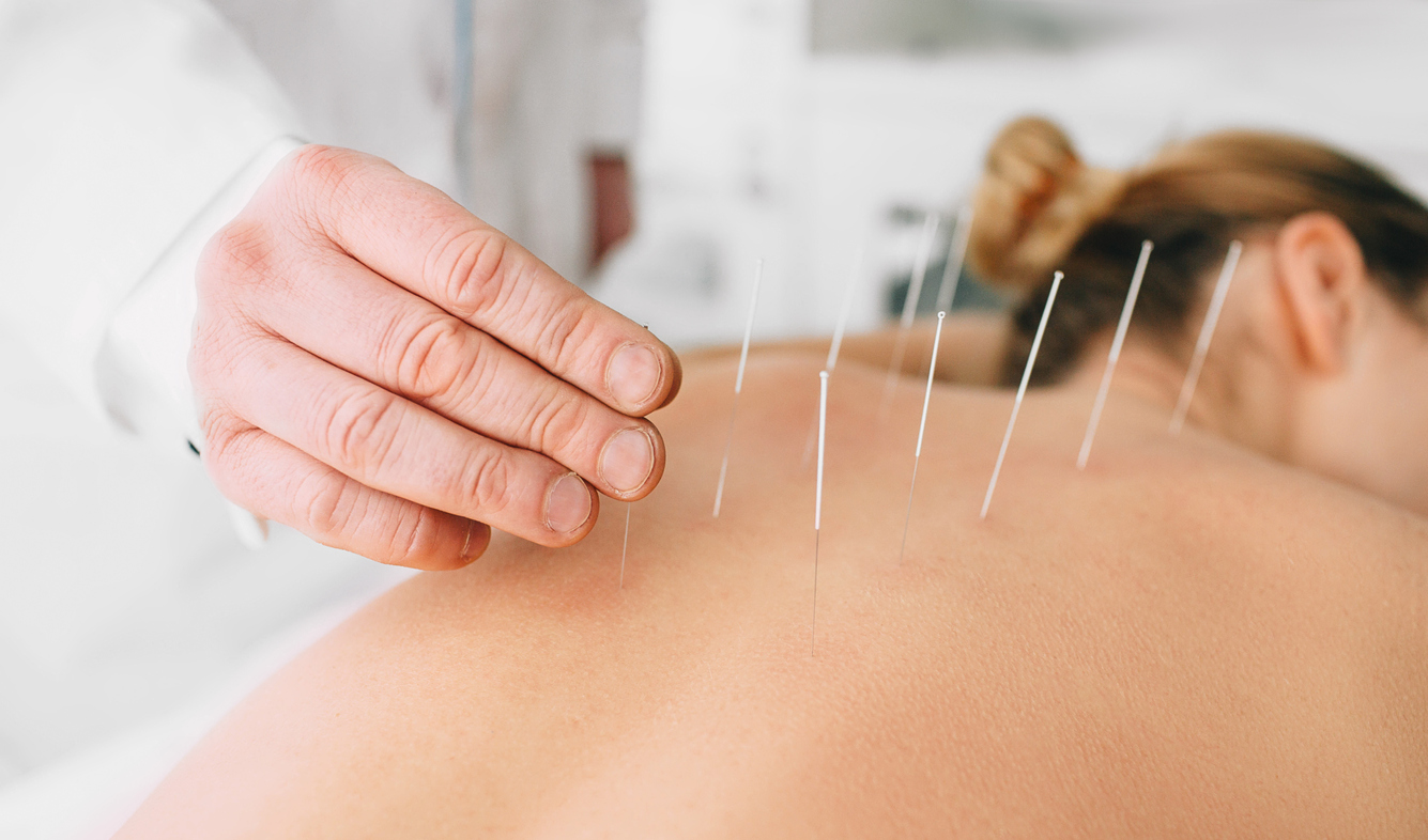 Acupuncturist inserting a needle into a female back. patient having traditional Chinese treatment using needles to restore an energy flow through specific points on the skin.